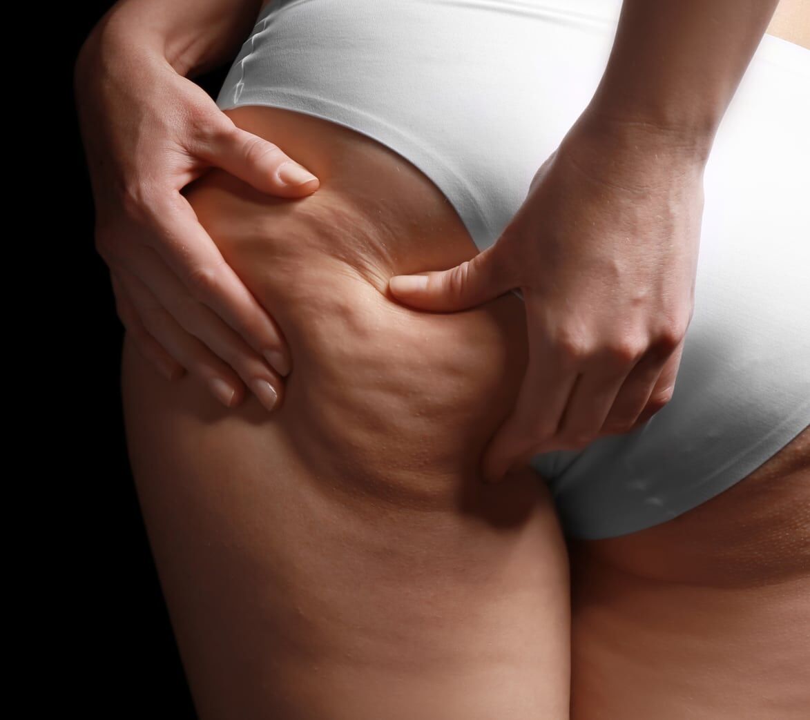 Cellulite reduction treatments | How to get rid of cellulite