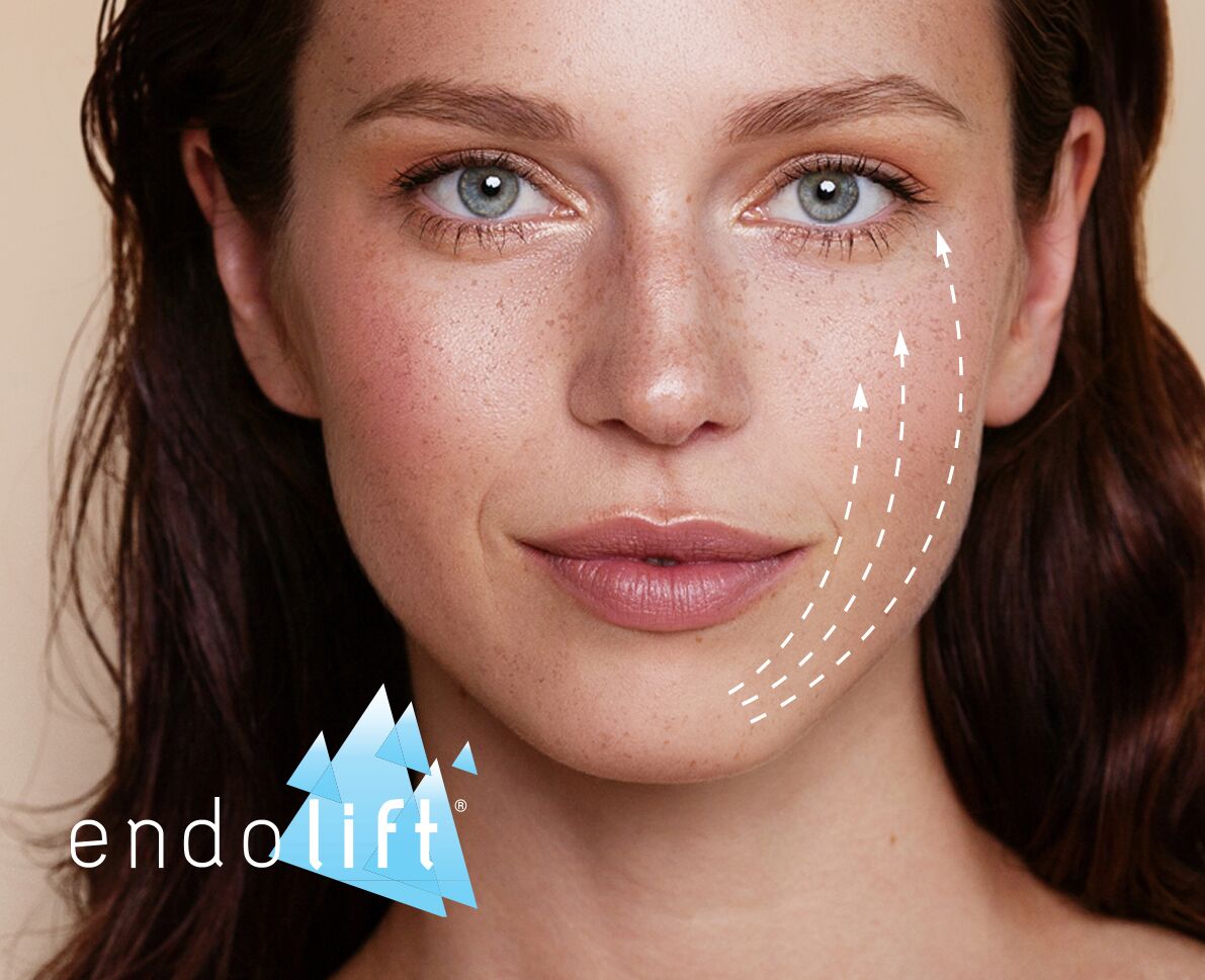 Endolift Cost Uk